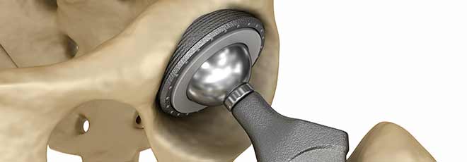 Wright Hip implant