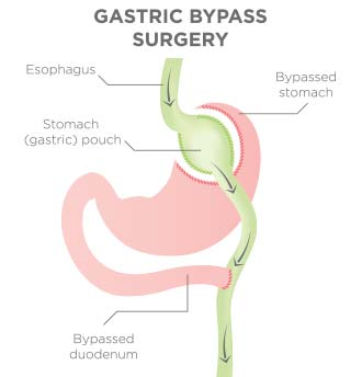 Illustration of Gastric Bypass Surgery