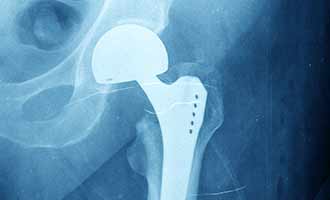 hip xray of the DePuy Hip device