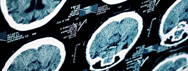 X-Ray of TBI or Traumatic Brain Injuries Caused by a Fall