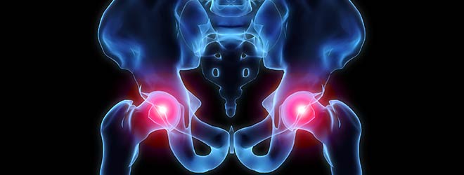 illustration of human hip showing hip injuries