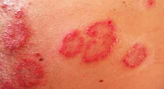 skin disorders have many effects like rashes