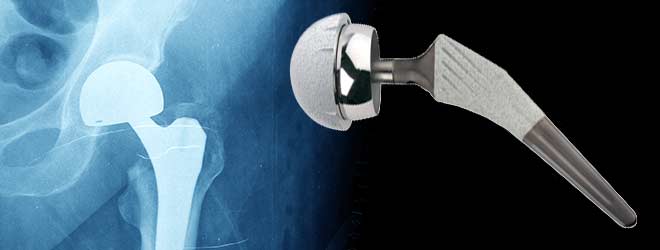 Stryker Hip Implant Lawsuits