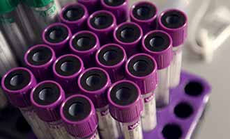 vials of blood to test for autoimmune disorders