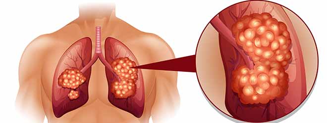 Diagram of lungs suffering from mesothelioma.