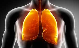 Diagram of a patient's lungs after being exposed to beryllium.