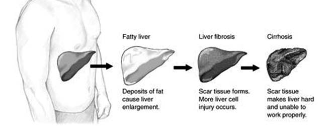A graph of the stages of liver disease.