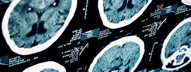 x-rays of motorcycle accident brain injuries