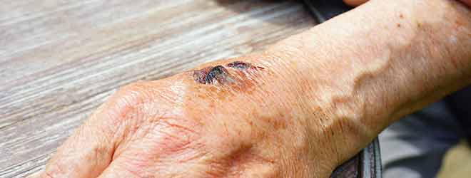 Sign of Nursing Home Abuse in Rhode Island
