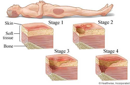 stages of pressure sores and stages of bedsore development