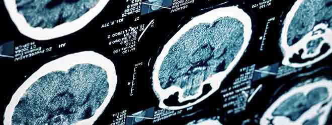 X-rays showing Traumatic Brain Injuries