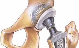 Femoral head hip replacement illustartion.
