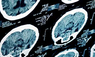Defective Bicycle head injury