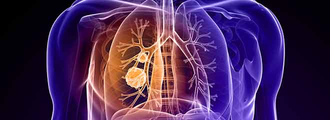 Asbestos lung cancer diagram