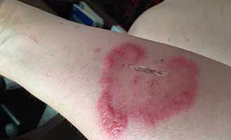 burn injury on arm
