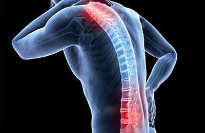 Spinal injuries to vertebrae ligaments and disks of the spinal column from a car accident