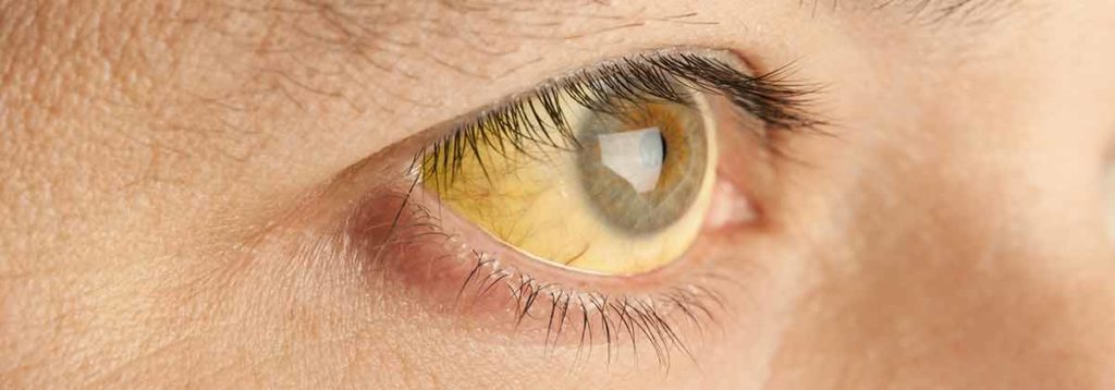 A yellow eye with jaundice of a man suffering from hepatitis.