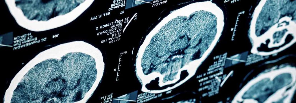 Brain Scan for Neurological Disorders