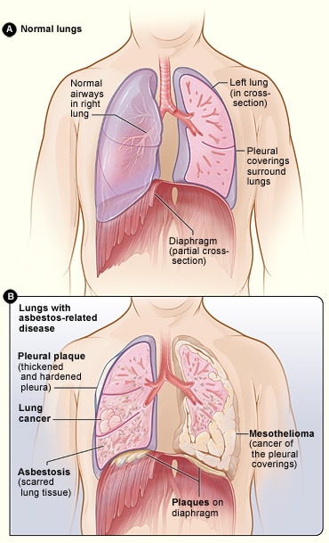 illustration showing normal healthy lungs and lungs with asbestos-related disease 