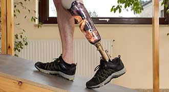man with leg amputation