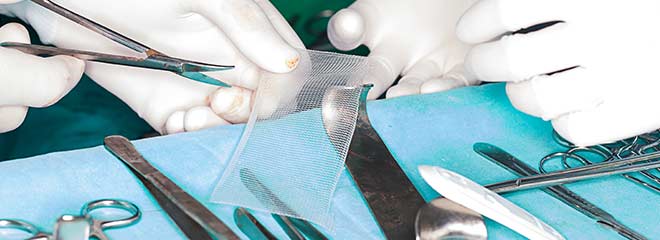 Surgeons cutting a Bard Hernia Mesh