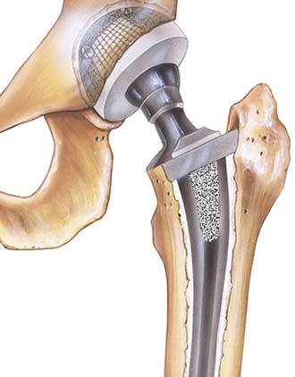 An illustration of a metal on metal implant.