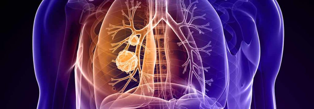 An illustration of someones lungs being infected with Mesothelioma.