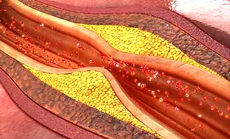 An illustration of arteries narrowing