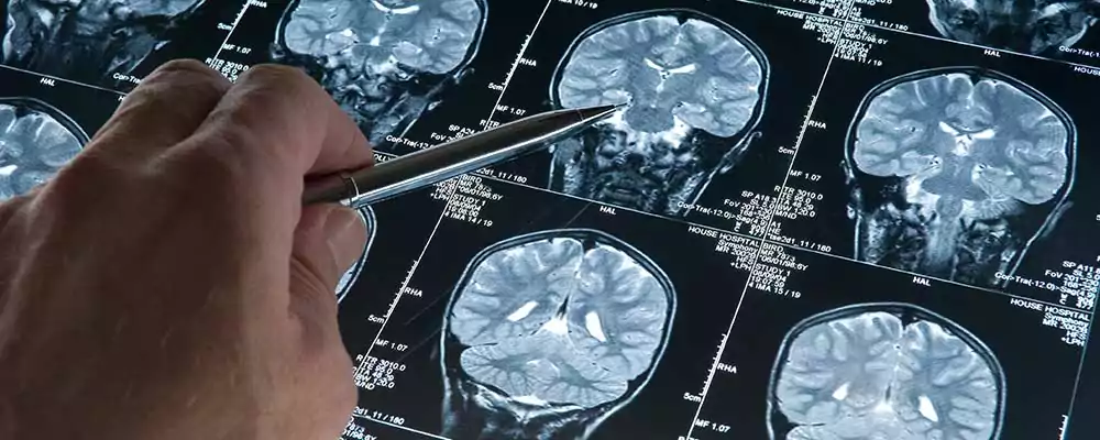Multiple CAT scans of the brain. 