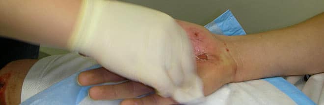 Medical professionals treating a dog bite