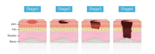 Different stages of bed sores
