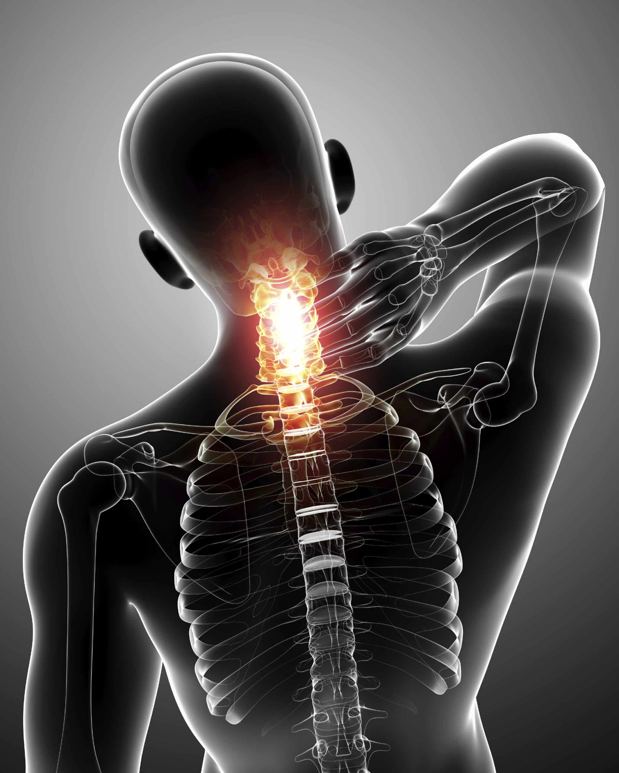 X-ray illustration of neck pain.