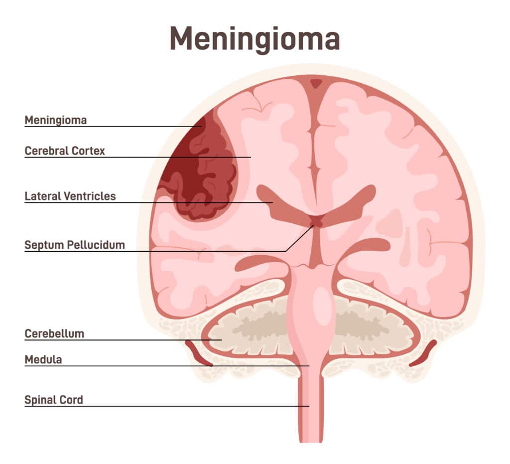 Meningioma Diagram