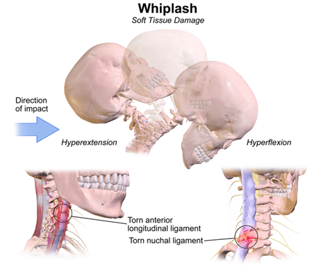 A diagram showing a whiplash.