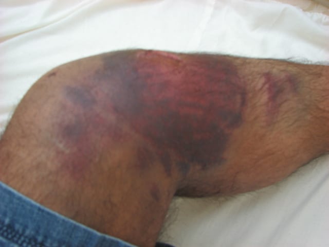 Man with large bruise on his knee after a car accident